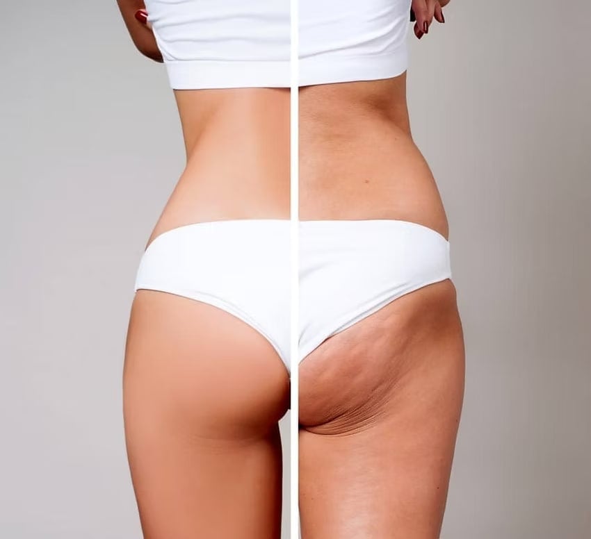 Sculptra Butt Lift