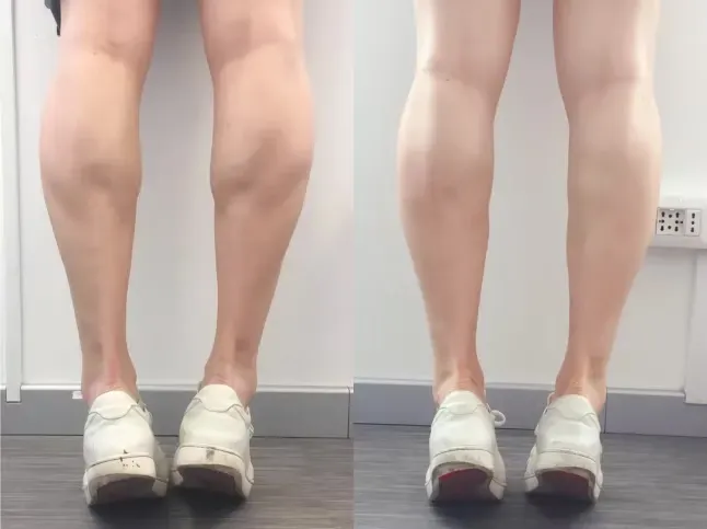 Calf Reduction Botox