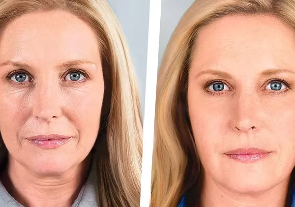 Dermal Fillers for Nasolabial Folds