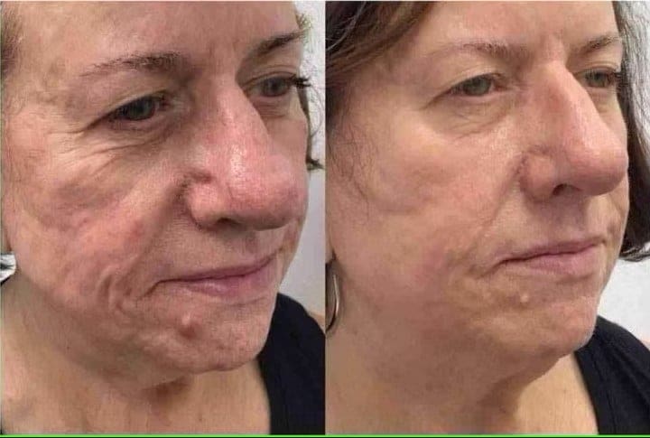 Radiofrequency Microneedling