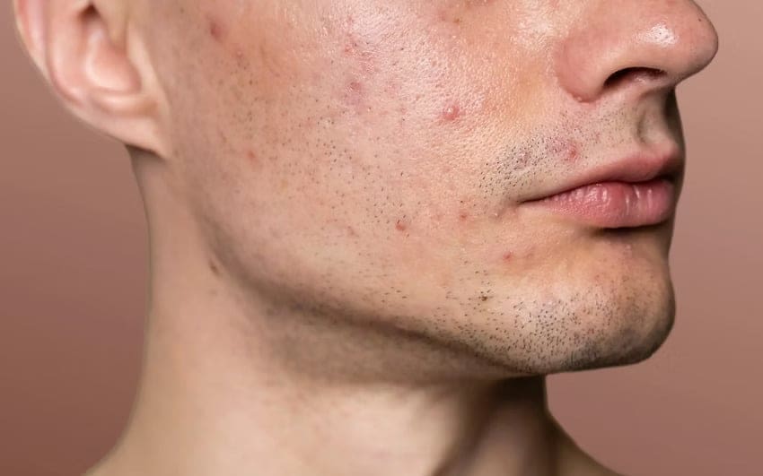 Anti-Acne Facial