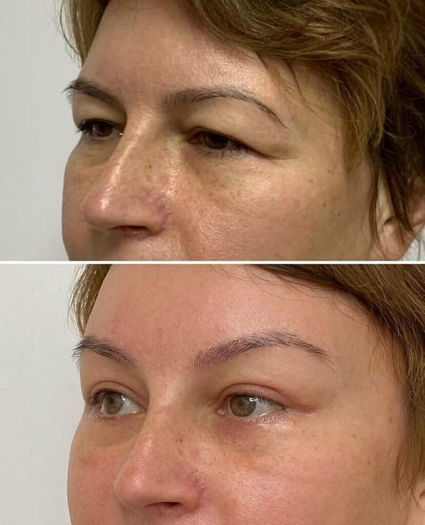 Botox Eyebrow Lift