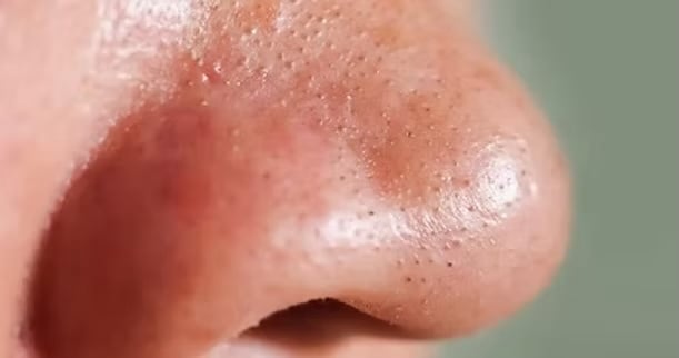 Blackheads