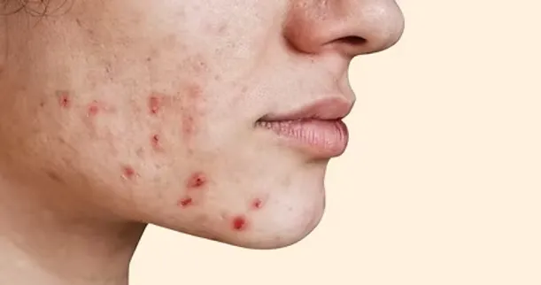 Breakouts and Acne
