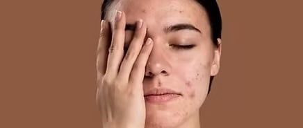 Breakouts and Acne