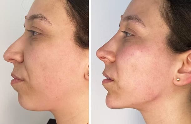 Endo Laser Lift