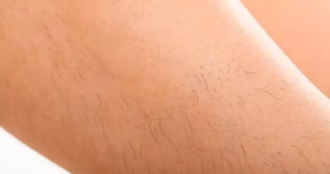 Excessive Hair Growth
