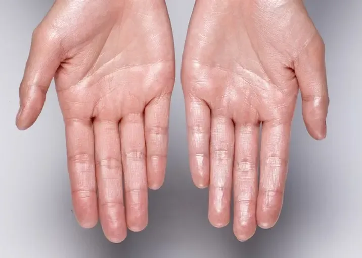 Hyperhidrosis
