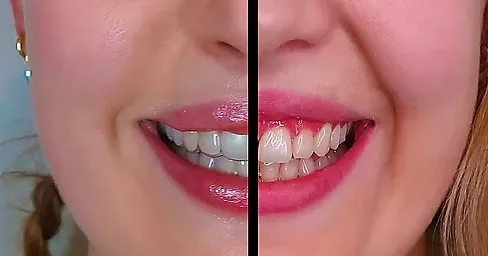 Botox for Gummy smile