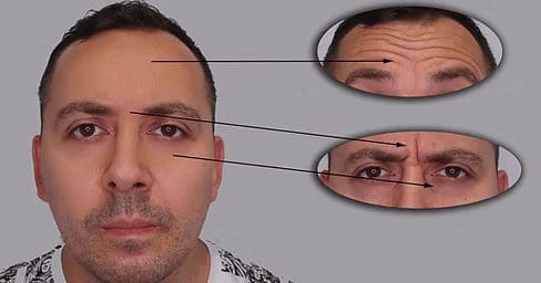 botox for Men