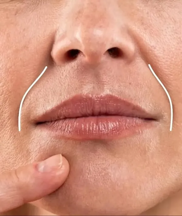 Dermal Fillers for Nasolabial Folds