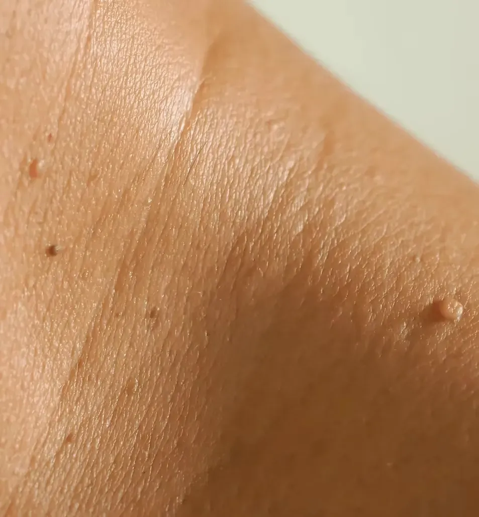 Moles Skintags Lump warts