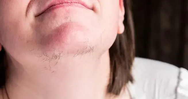 PCOS