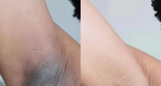 Dermamelan Intimate Peel