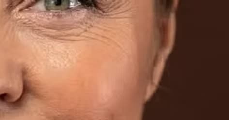 Wrinkles and Fine Lines