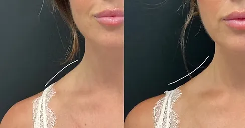 Botox for Trapezius