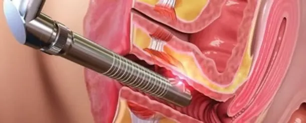 Laser Vaginal Tightening