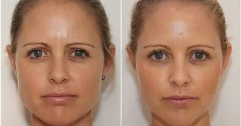 Masseter Botox