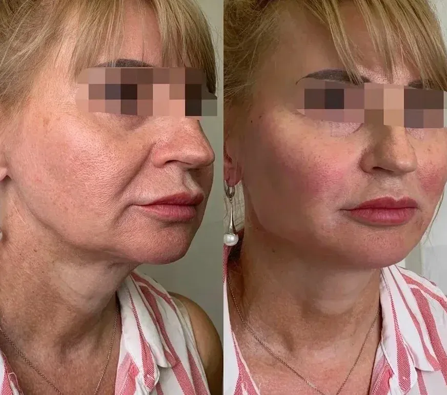 Non-Surgical Facelift