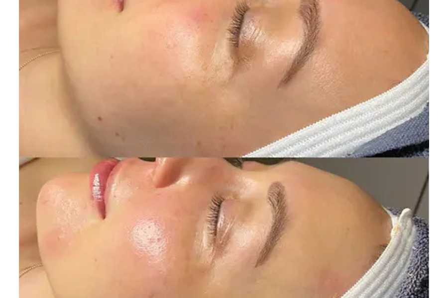 Hydrafacial Blackhorse Before and After: What You Need to Know