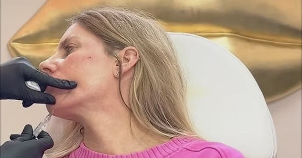 Sculptra Filler for Face