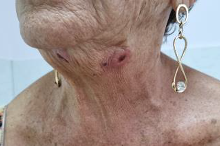 Side Effects of Endolift Laser Treatment: What You Need to Know