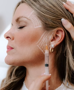Sculptra injection side effect