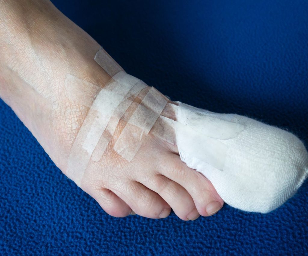Toenail Surgery