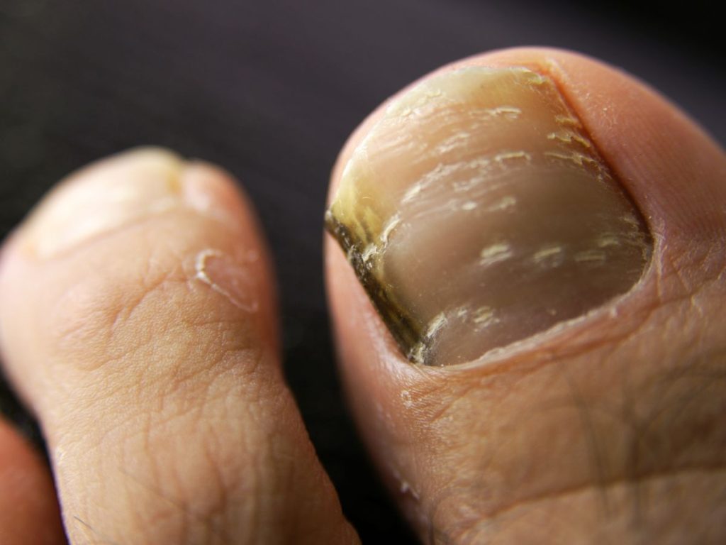 Toenail Surgery