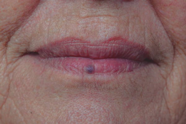 Venous Lake Lip Treatment in London – Safe and Effective Removal