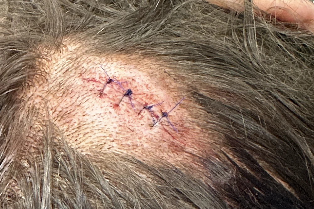 Lump and Cyst Removal