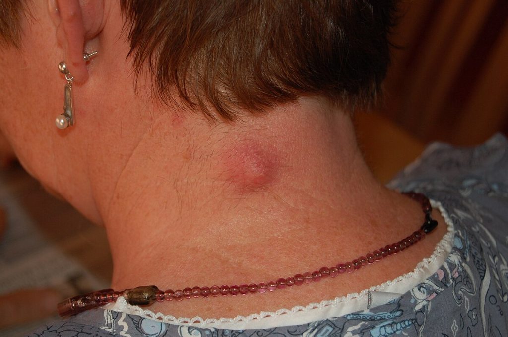 Lump and Cyst Removal