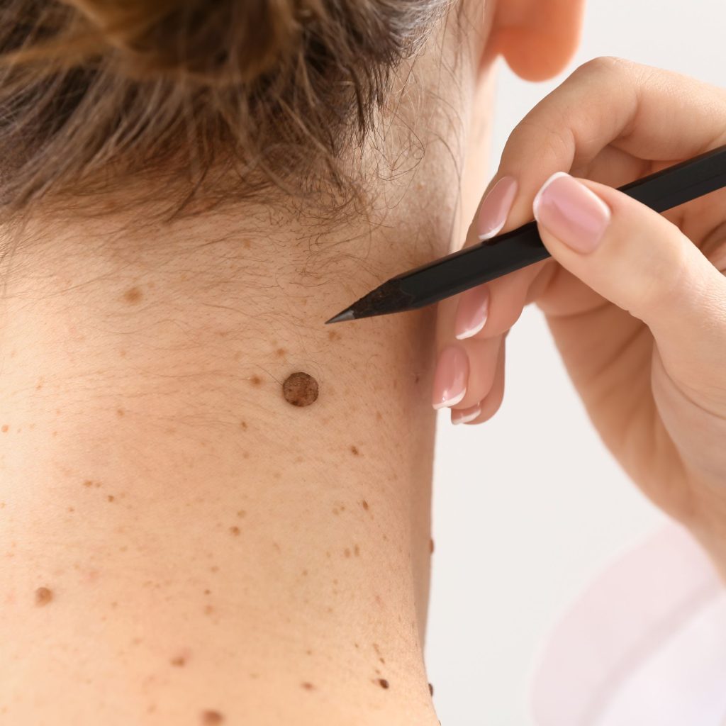Mole Removal