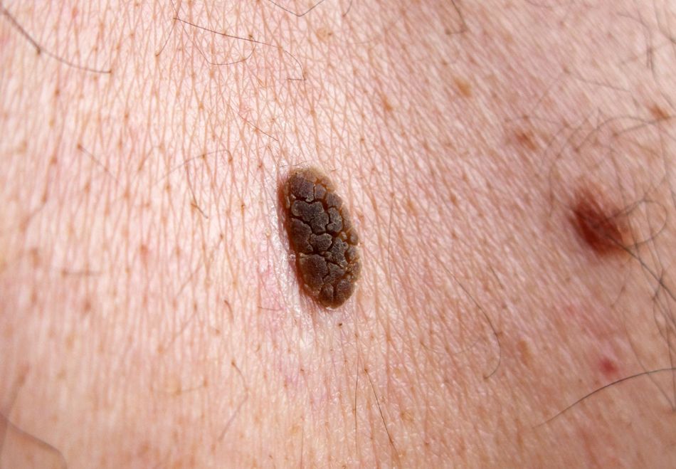 Seborrhoeic Keratosis