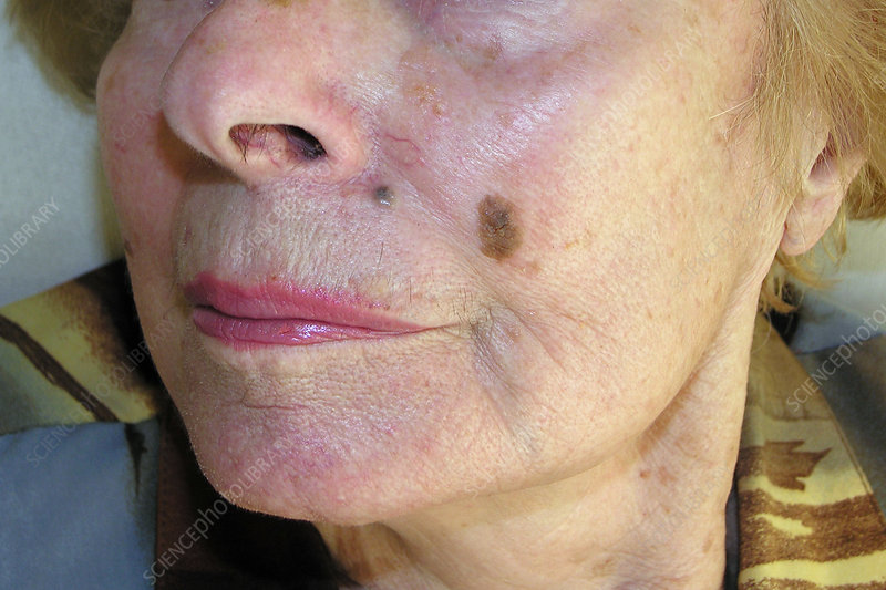 Seborrhoeic Keratosis