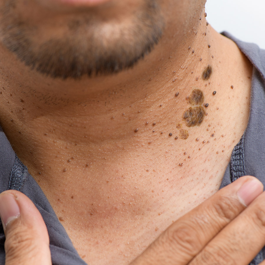 Seborrhoeic Keratosis