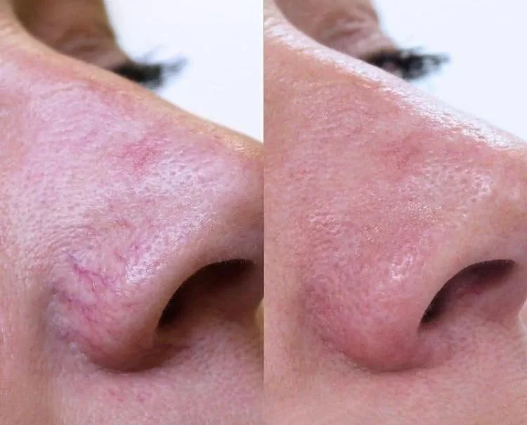Electrolysis Thread Vein Removal on the Face