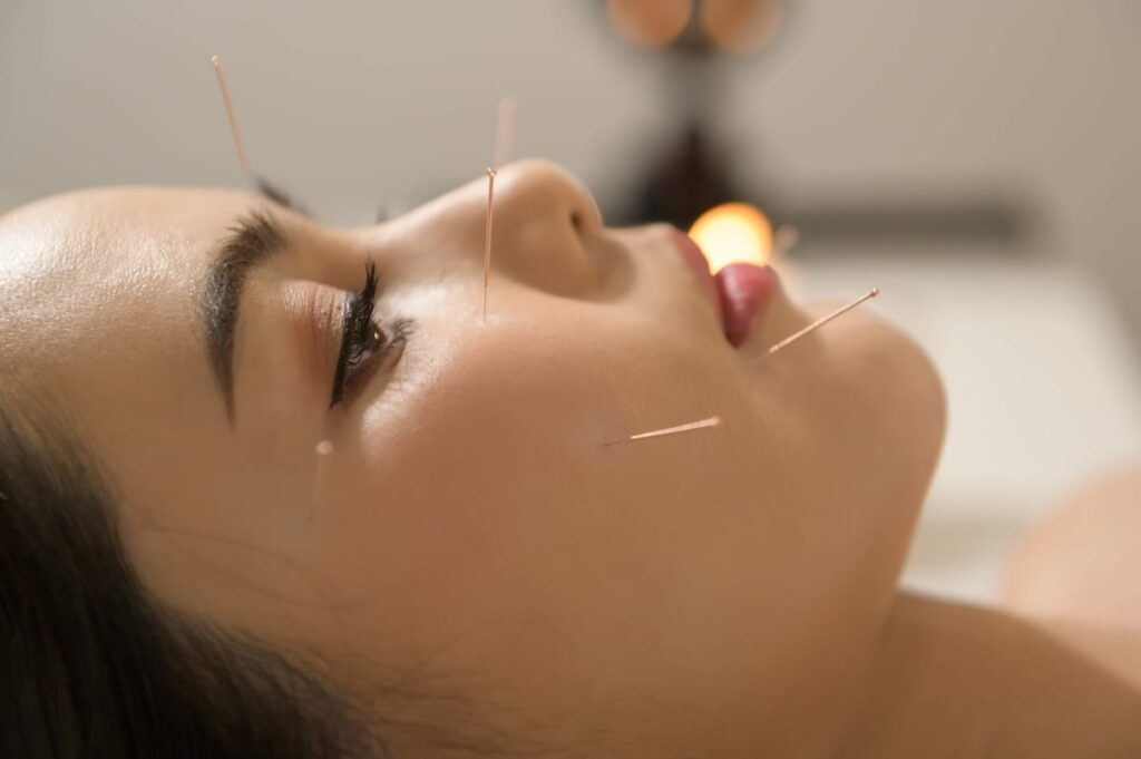 Why choose Skinoza Clinic for cosmetic facial acupuncture in London