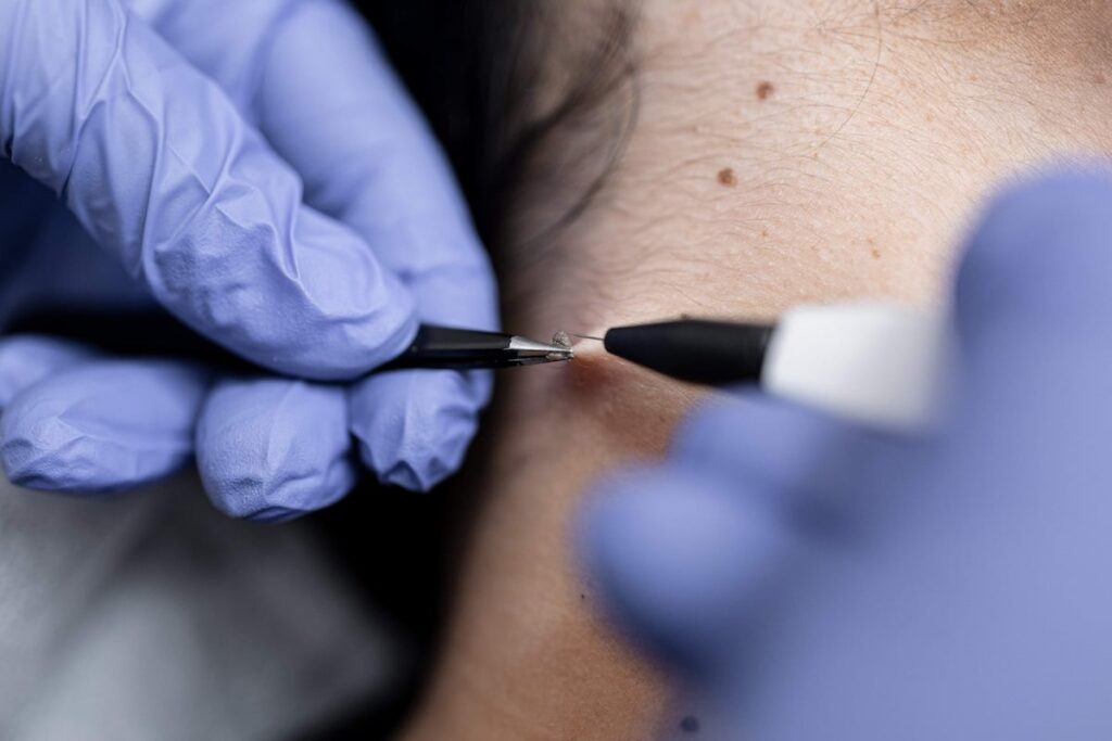 Close-up of skin tag removal at Skinoza Clinic — gloved practitioner using fine forceps and an electrocautery pen to remove a benign skin tag in a quick in-clinic London procedure